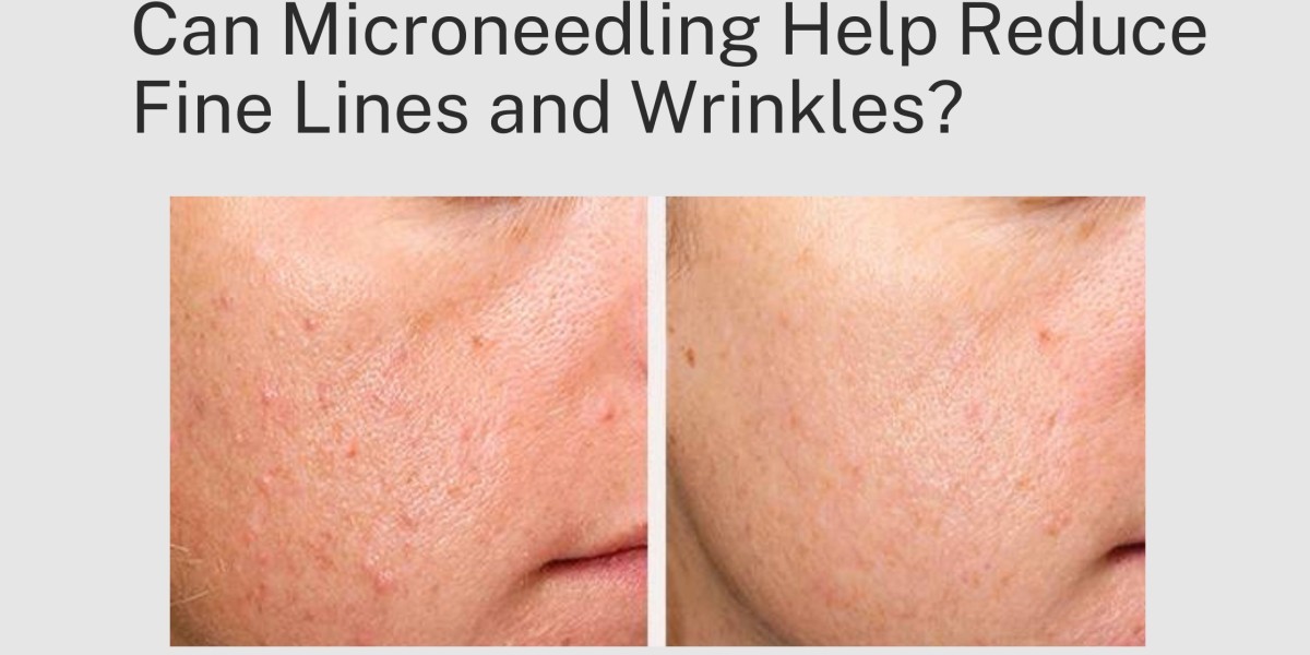 Can Microneedling Help Reduce Fine Lines and Wrinkles?